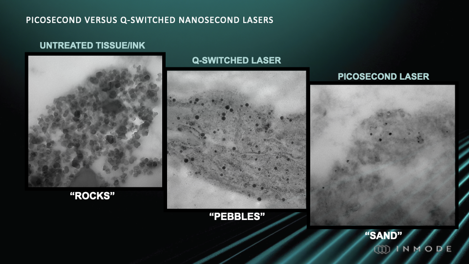 pico vs nano lasers for tattoo removal