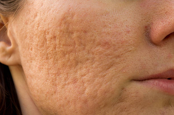 RF microneedling can improve acne scars