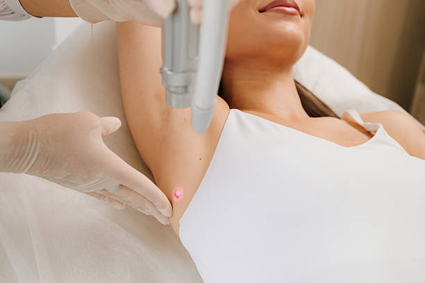 laser hair reduction