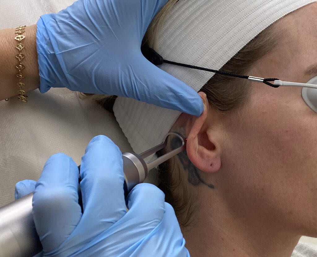 laser tattoo removal at Ecocene Medical Spa