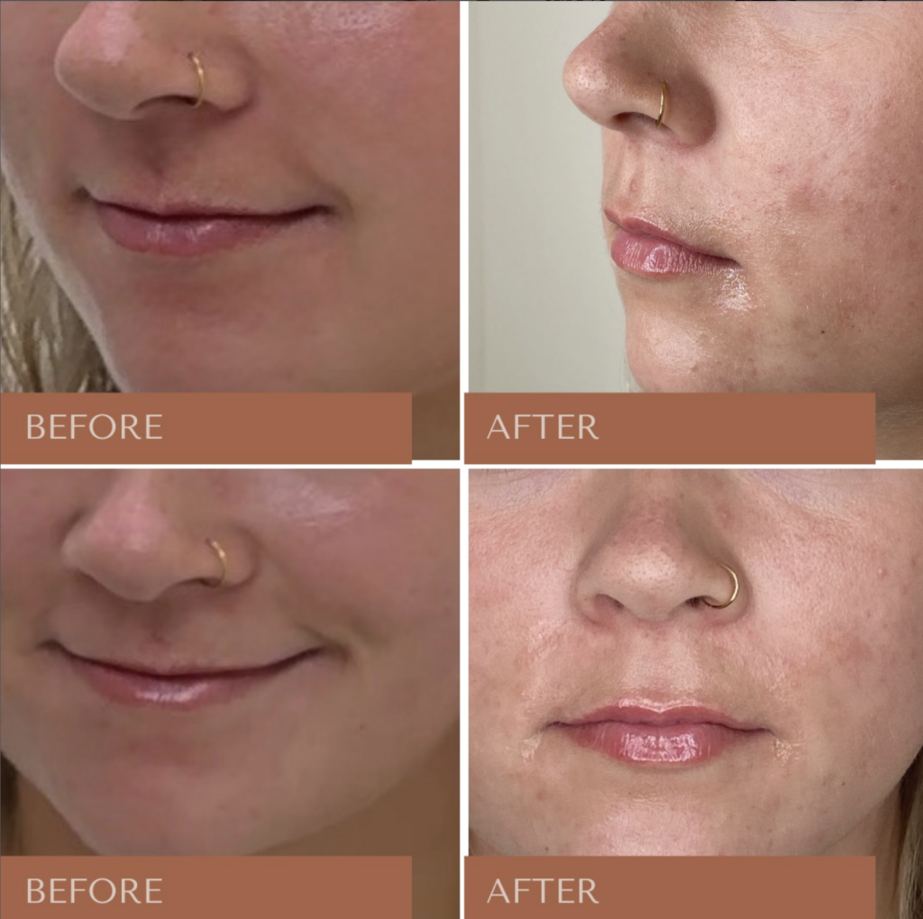 Lip filler for lip enhancement treatment at Eocene Medical Spa by Megan Rawlings RN BSN