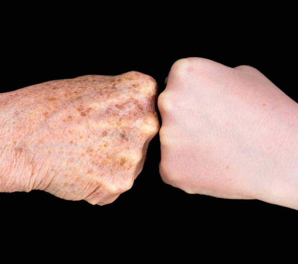 solar lentigo age spots on hands