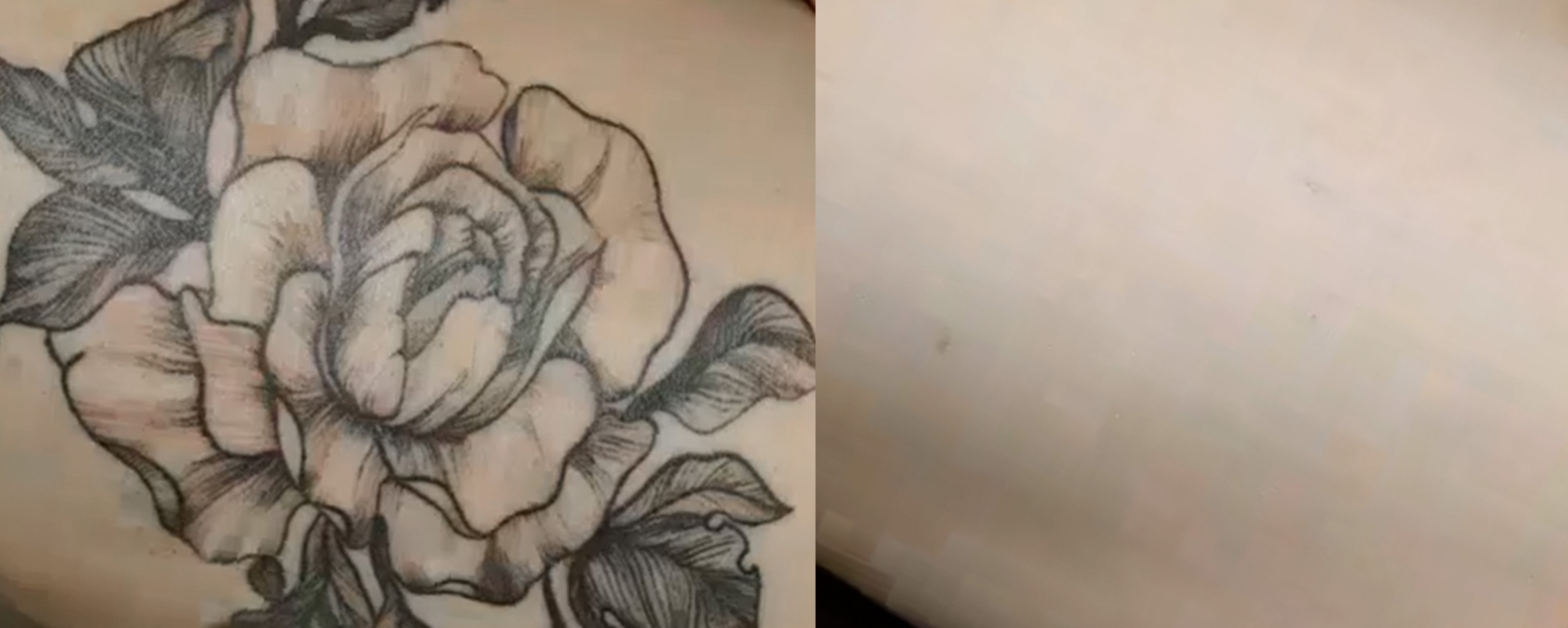 Tattoo Removal with Picofy