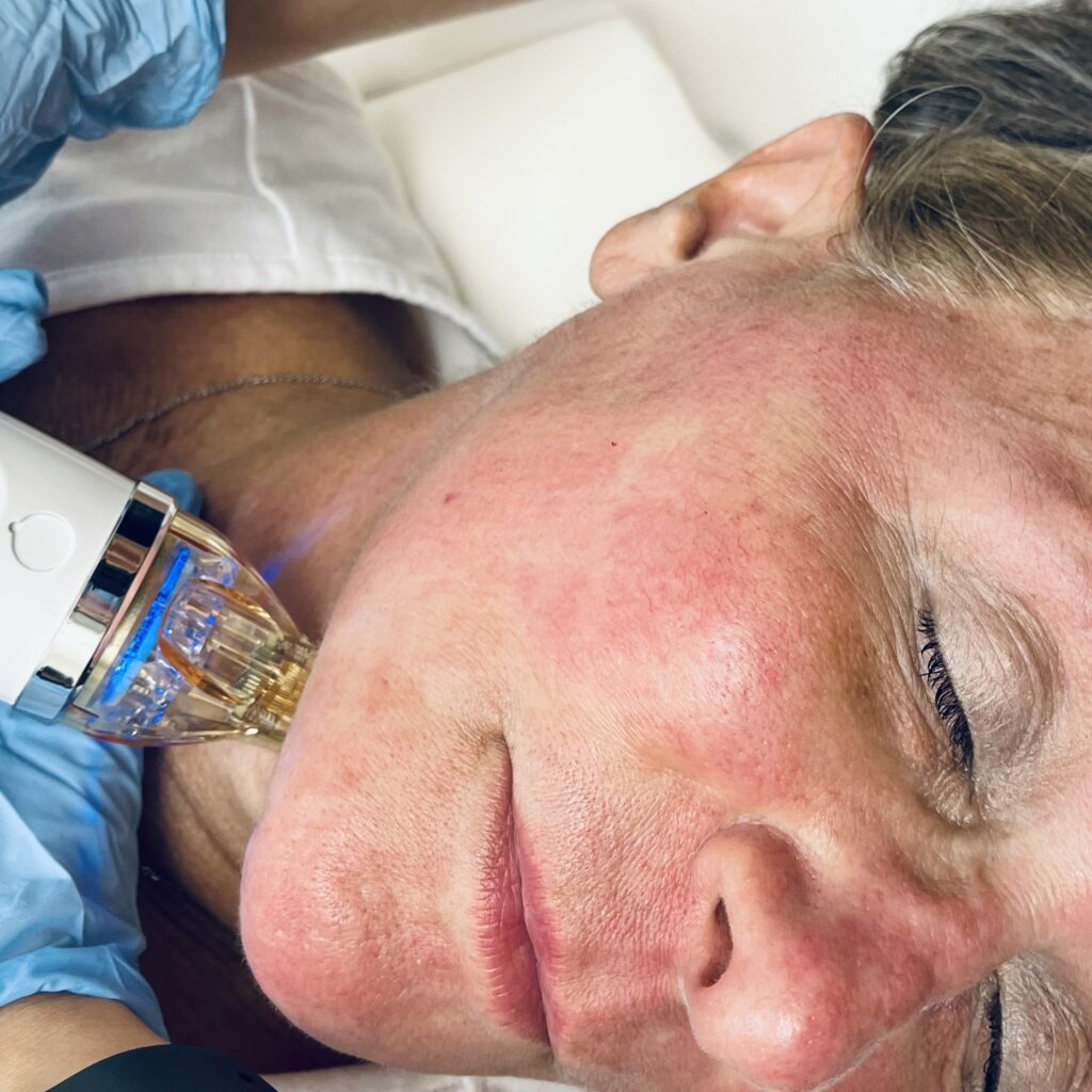 RF microneedling at Eocene Medical Spa