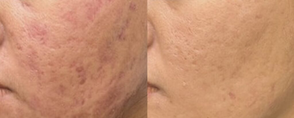 Acne scars treated with picofy picosecond laser