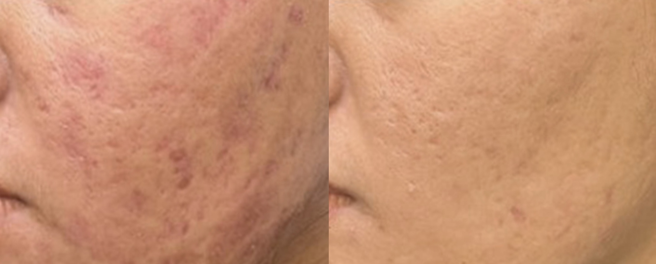 Acne scars treated with picofy picosecond laser